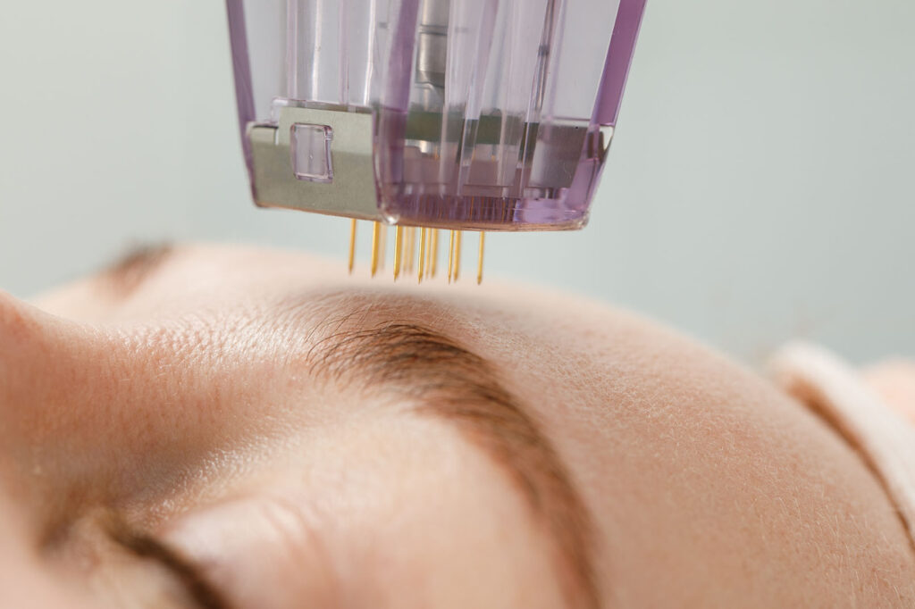 RF microneedling device for face rejuvenation session.
