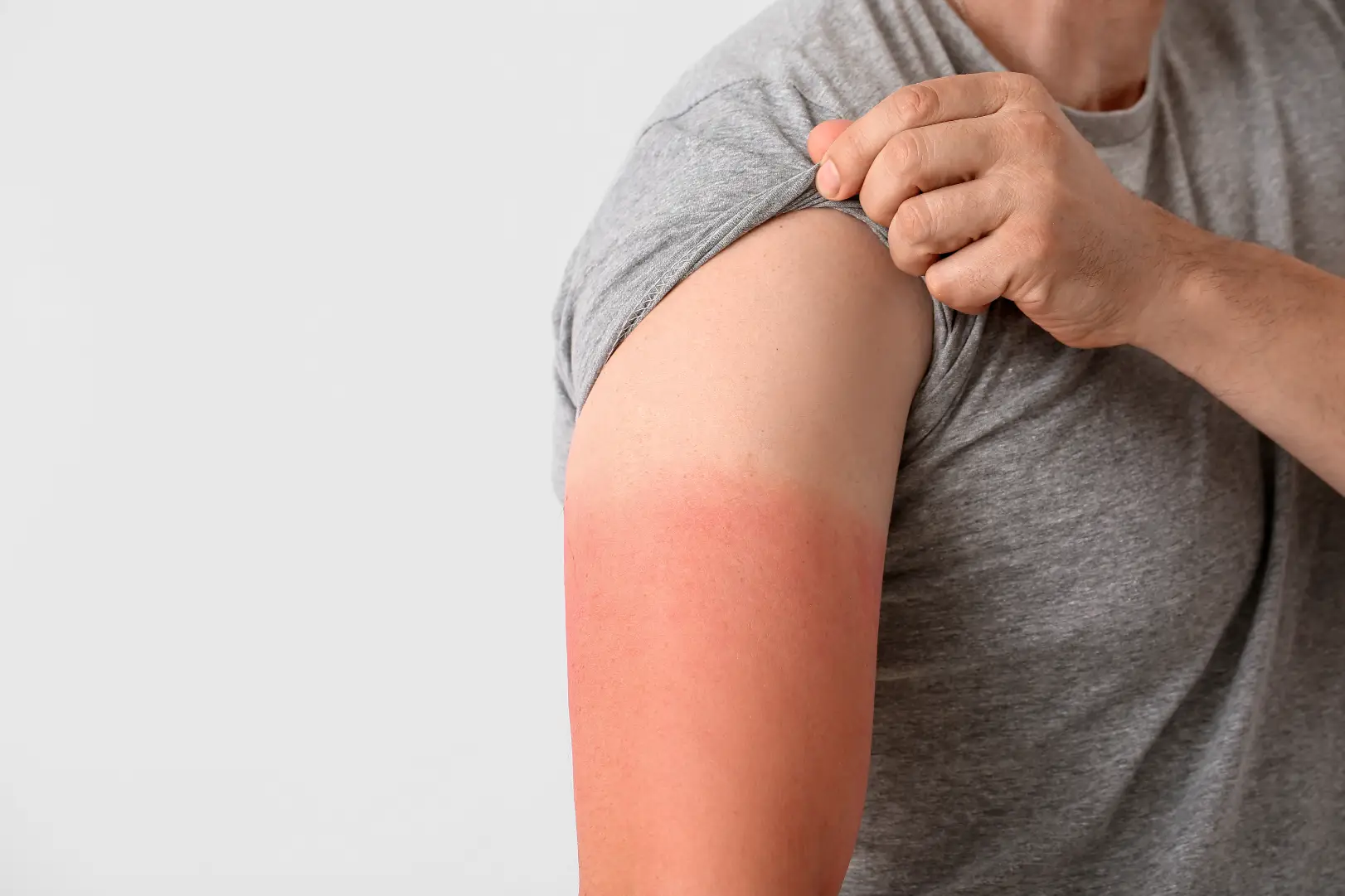 Person lifting a sleeve to reveal a red sunburned upper arm.