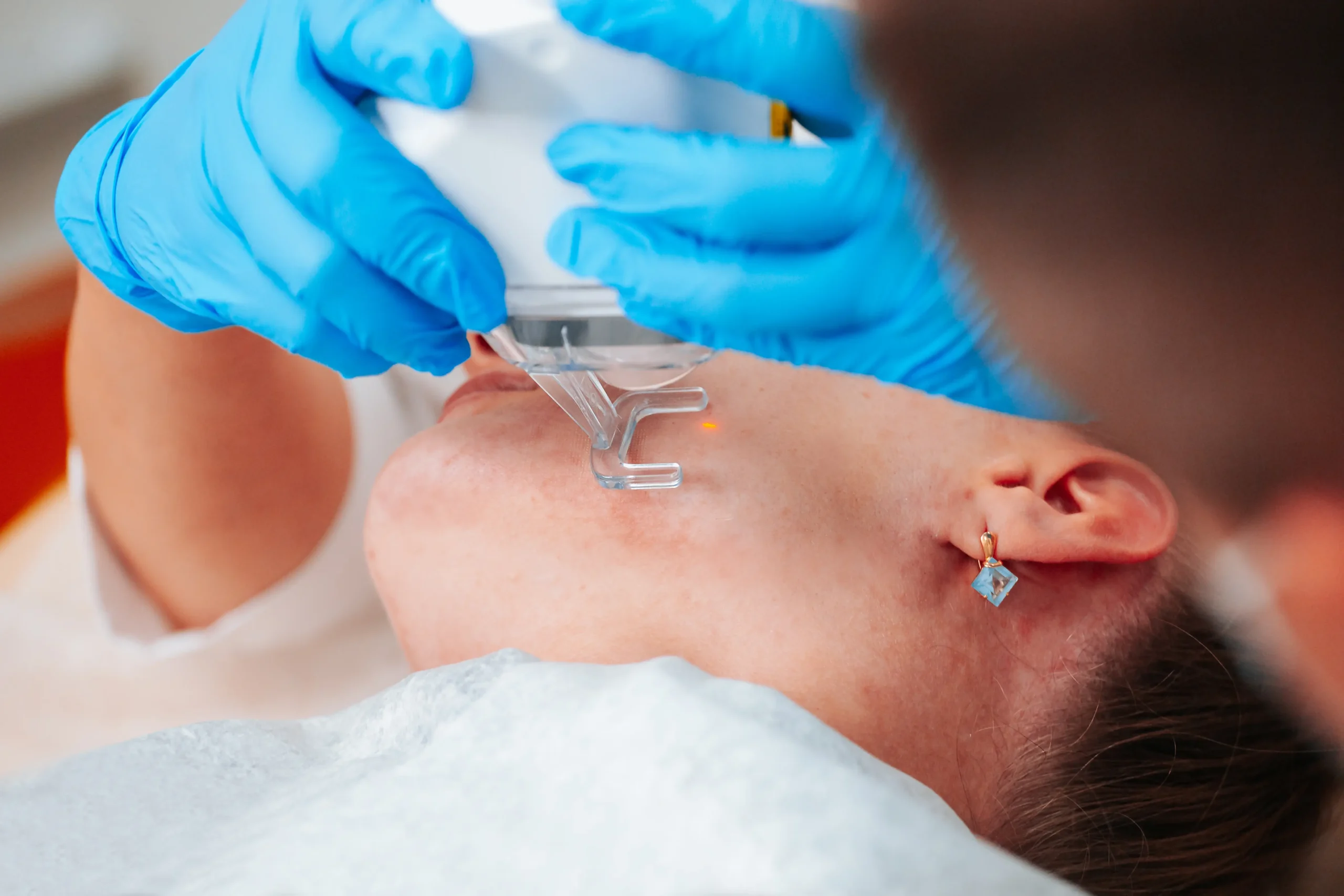 Practitioner performing a CO2 laser facial treatment on a patient's cheek with protective gloves.