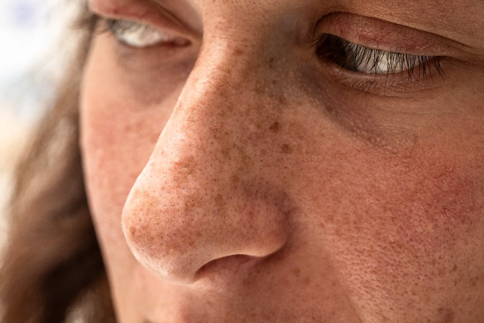 Close-up of a person's face showing freckles, dark spots, pores, and the area around the eyes and nose.