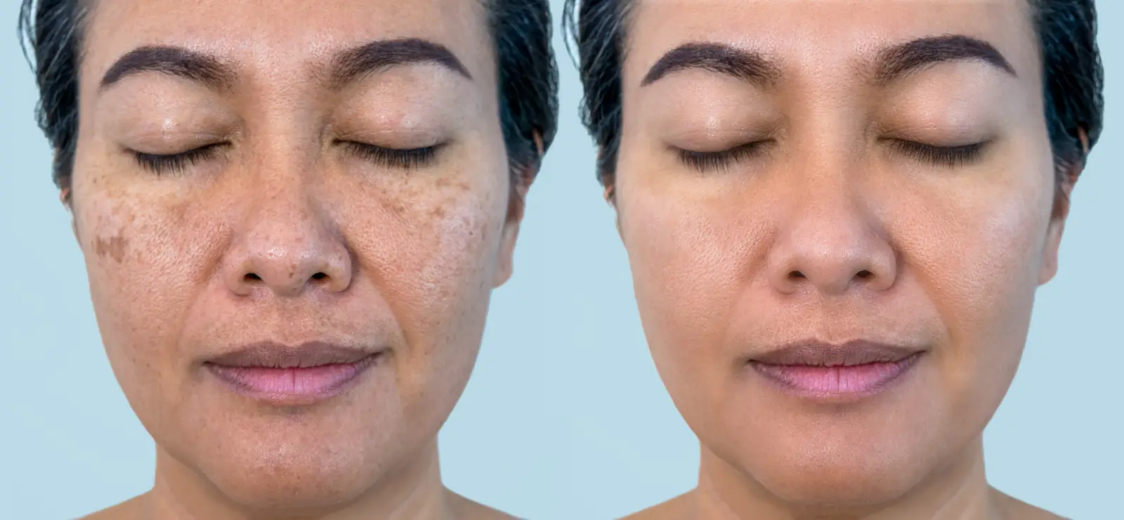 Left and right facial images show differences in visible dark spots, freckles, and overall skin coloration.